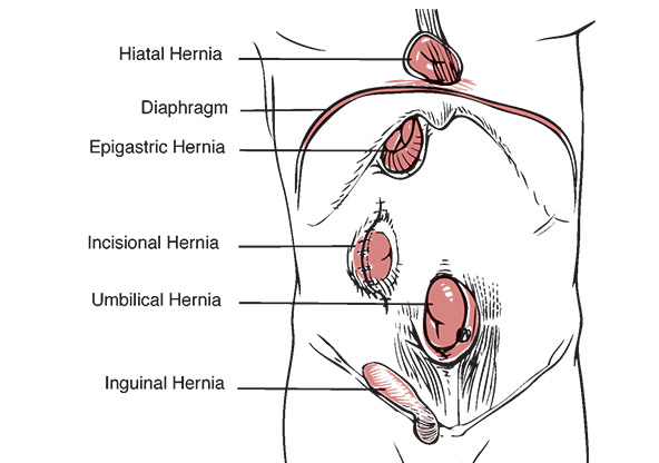 A medical illustration of the different types of hernias